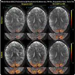 Higher spatial resolution and sensitivity in whole brain functional MRI at 7T using 3D EPI accelerated with variable density CAIPI sampling and temporal random walk