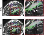 Advancing high-resolution 7 T diffusion MRI: Evaluating phase-encoding correction strategies for distortion correction from basic to four-way acquisitions